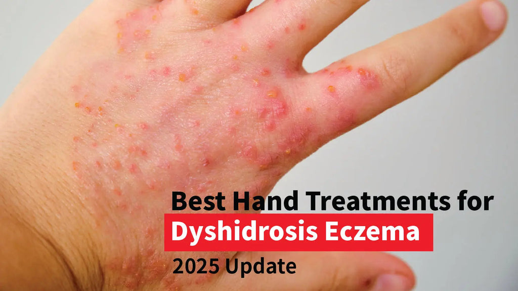 Best Dyshidrotic Eczema Hand Treatments (2026 Guide)  Ms. Chu