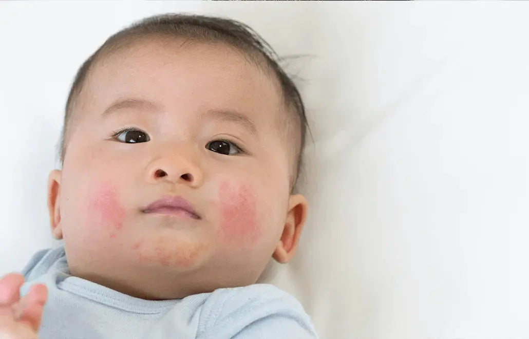 Tnep Rash Drool Rash: Causes, Prevention & Natural Treatment (2026) – Ms. Chu