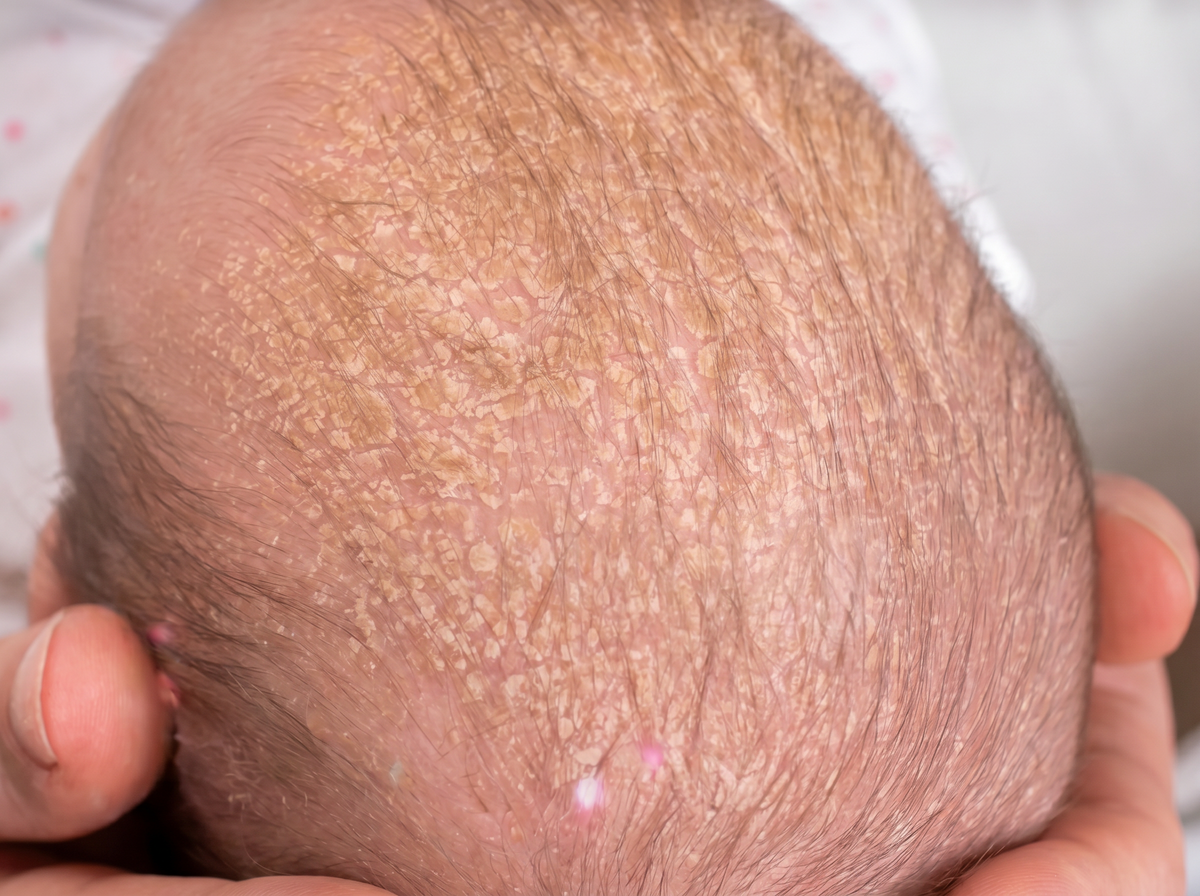 Close-up of baby scalp showing cradle cap seborrhoeic dermatitis condition