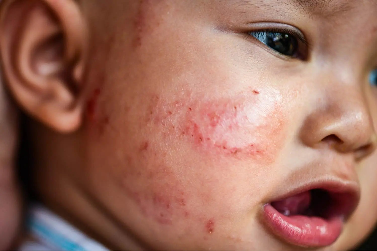 Eela Rashes Ms. Chu – NEA Accepted | Natural Eczema and Sensitive Skincare HK