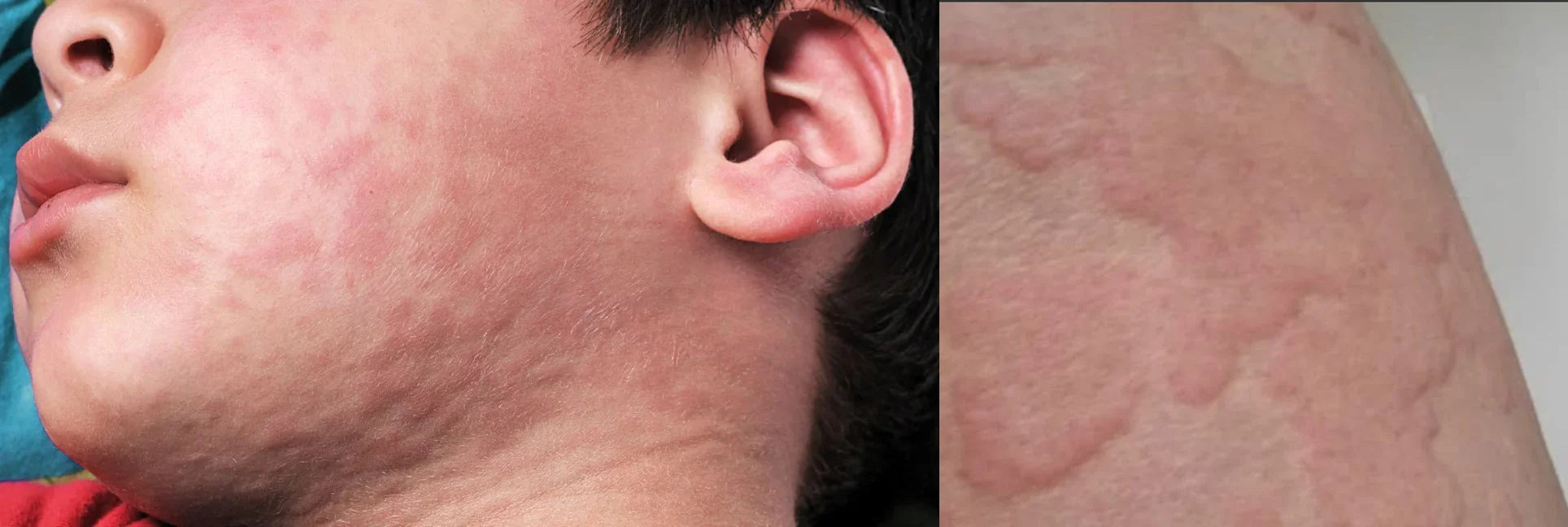 NEA Certified | Sweat Allergy & Urticaria (Hives) Treatments | Facial ...