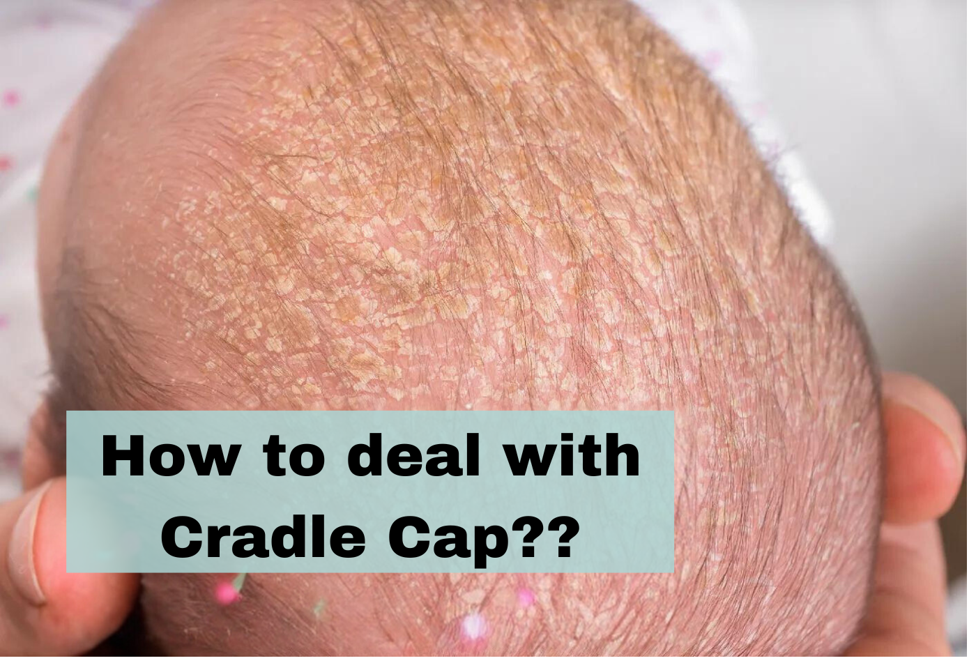 CradleCapThumbnail.png__PID:faf6479c-fe14-41e1-9d1c-1865b67fabe0